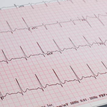ECG